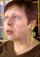 Lipome, zone cicatricielle (Silviane Le Menn)